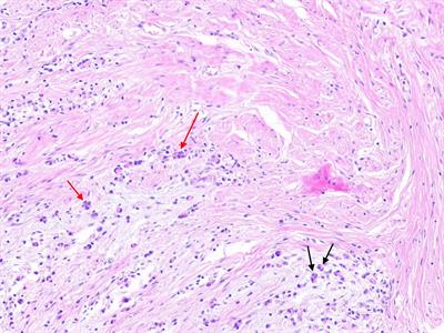 Tumor budding as a predictor for prognosis and therapeutic response in gastric cancer: A mini review